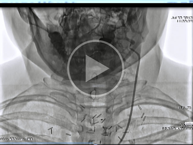 Svolta epocale nella cura della sclerosi multipla ad opera del cardiochirurgo italiano Salvatore Spagnolo